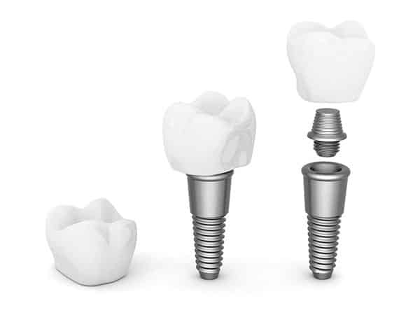 The Various Types of Dental Implants Used to Replace Teeth