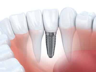 dental implants20163b