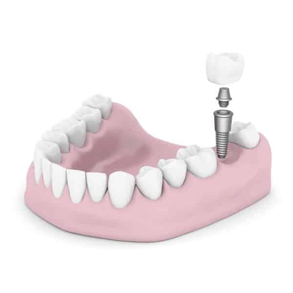 dental implants201511