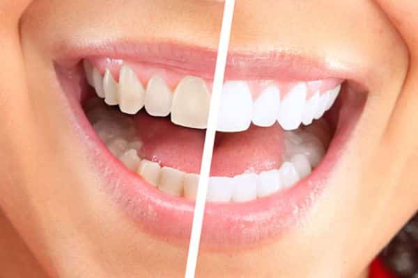 Is Dental Bonding in Leawood the Best Cosmetic Dentistry Option for Me?