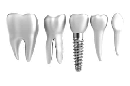 Dental Implants: Facts About This Innovative Technology