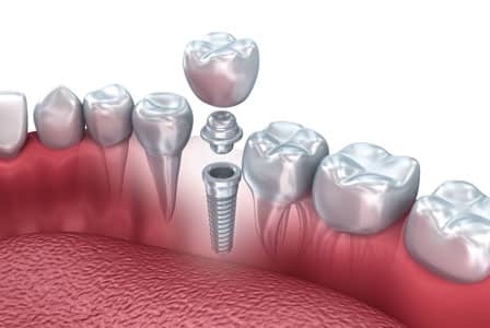 CEREC and Dental Implants