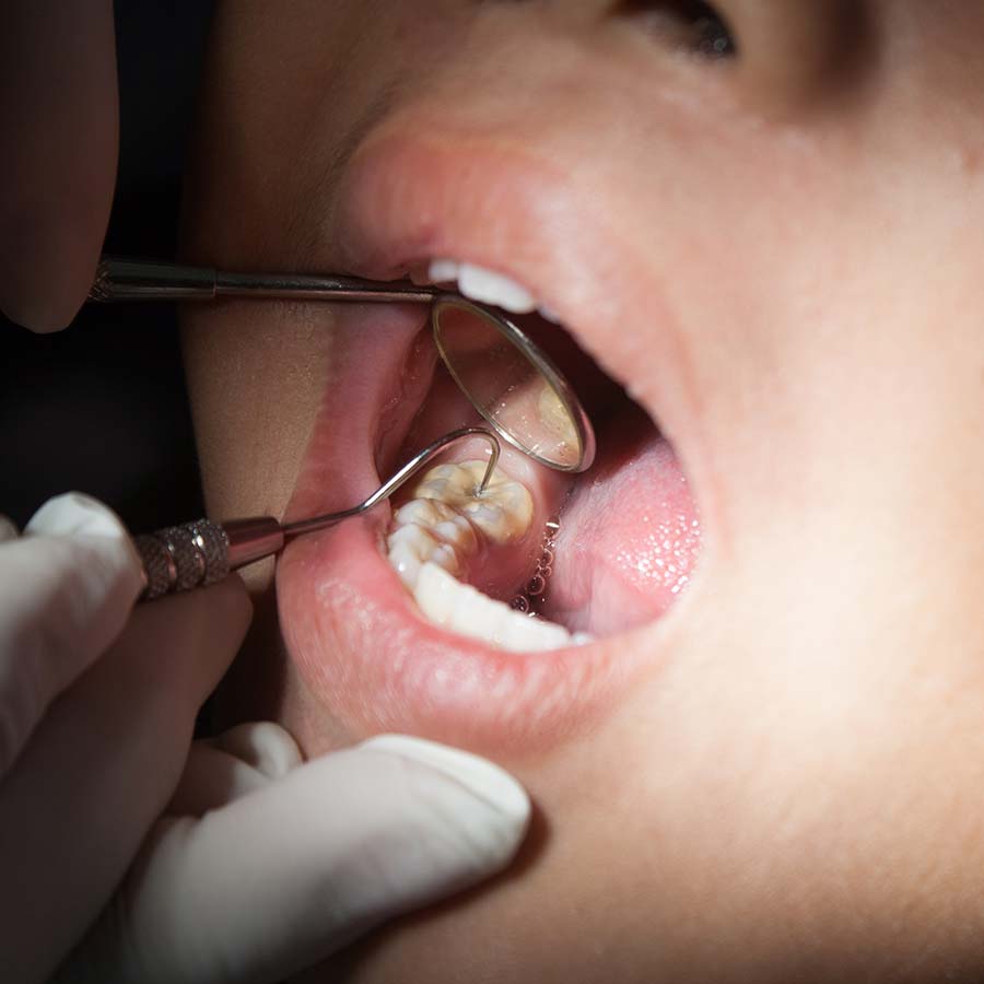 asha dental leawood ks Services Dental Sealants Image