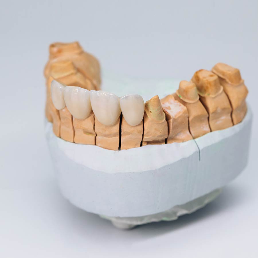 asha dental leawood ks Services Metal Free Restorations Image