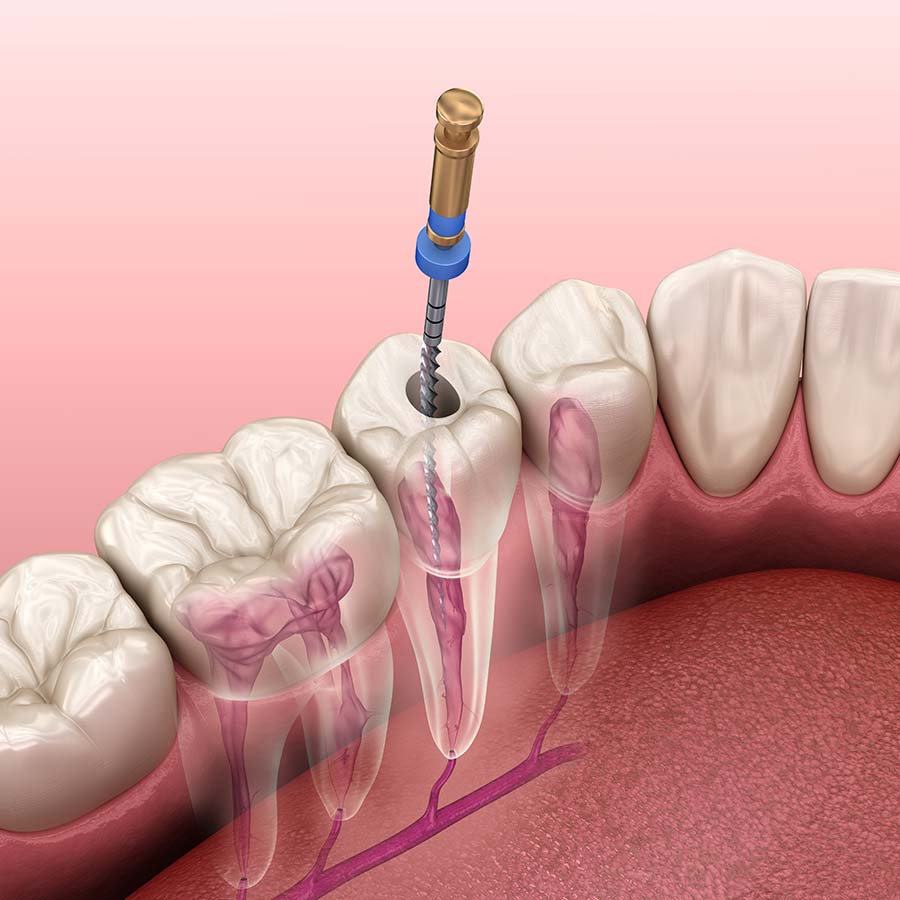 asha dental leawood ks Services Root Canal Therapy Image