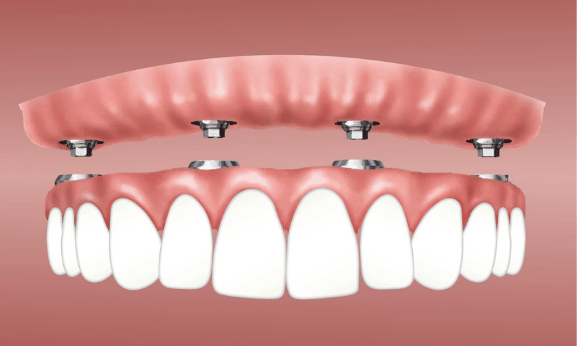 All On 4 Dental Implants