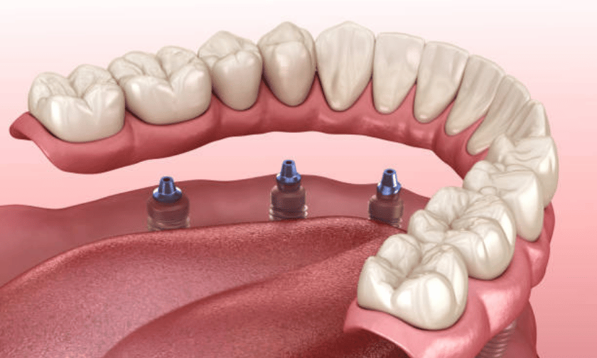 Long-Lasting Smile With Implant-Supported Dentures