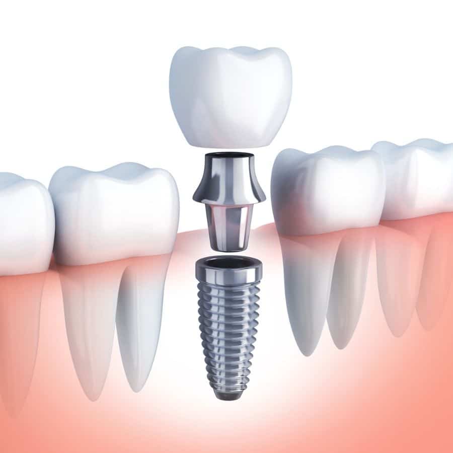 Implant Dentist in Leawood