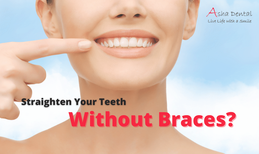 How To Straighten Teeth Without Braces?