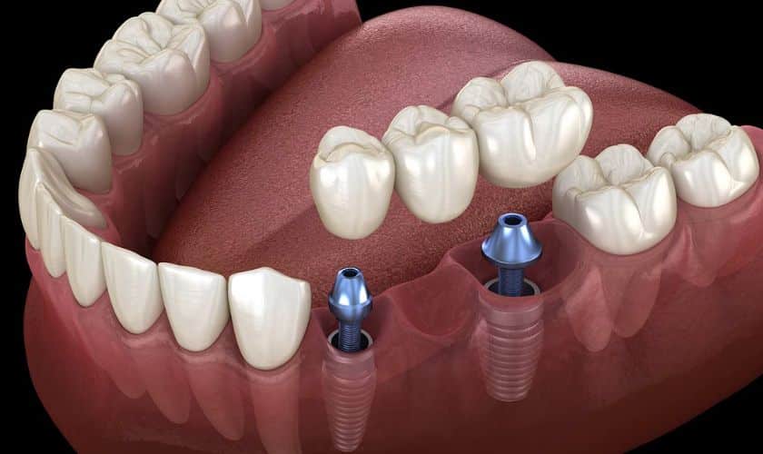 Advantages Of A Dental Implant Dentist Overland Park