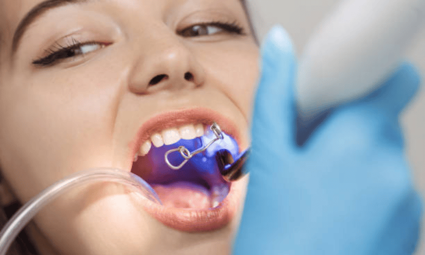 Dental bonding and the various benefits of it