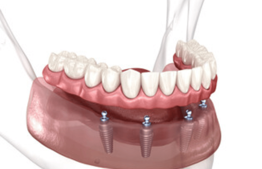 What are All-on-4 Dental Implants – Advantages & How They Work?