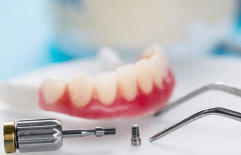 Implant Supported Overdenture Versus All On 4 Denture