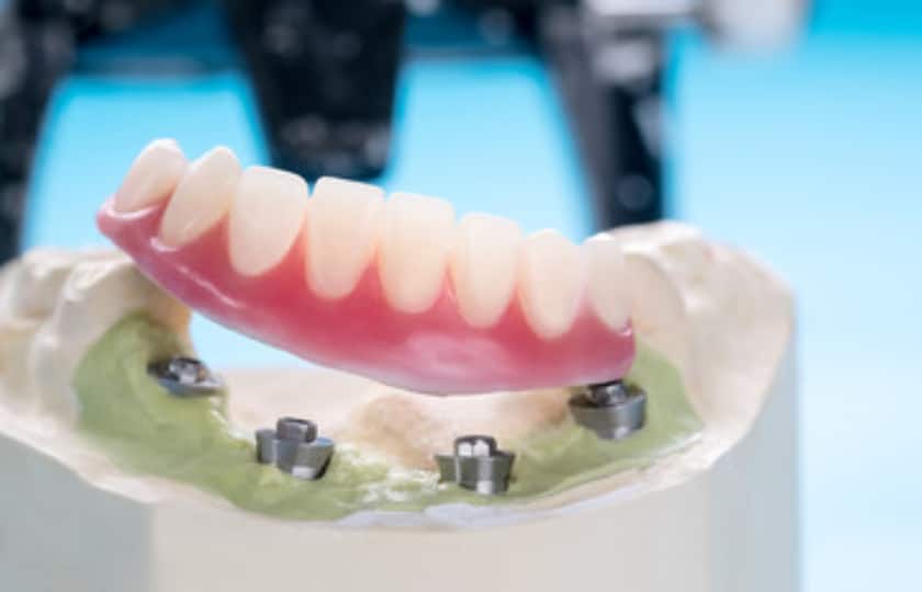 How To Care for Your Implant-Supported Dentures?