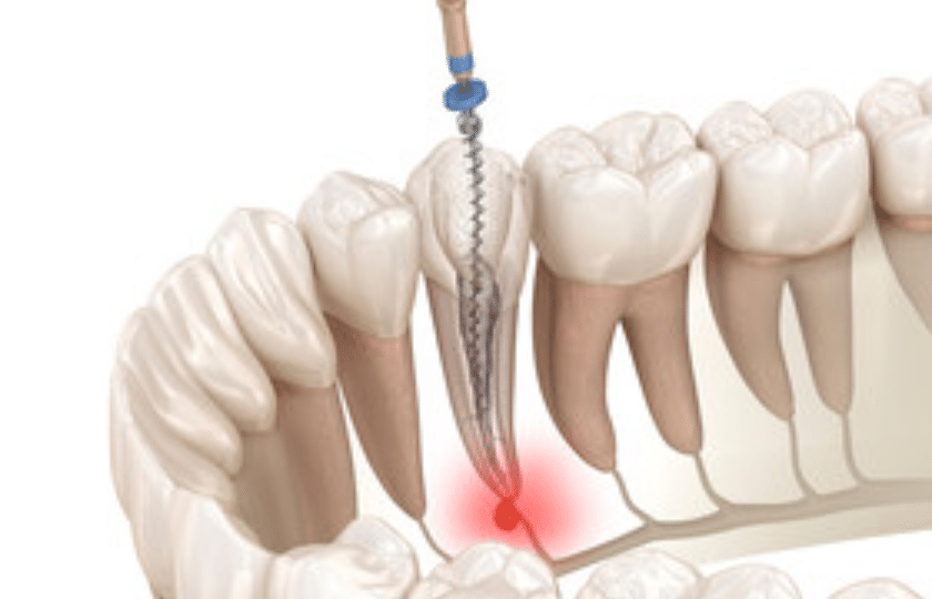 How Root Canal Therapy Treats Decayed Teeth?