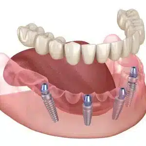 asha dental leawood ks Services Clear Aligners Image