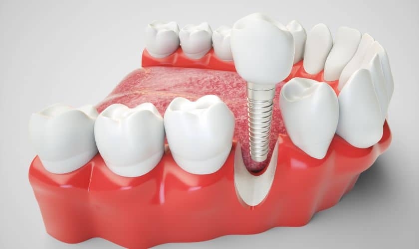 Are Dental Implants Right for You? Overland Park Experts Weigh In