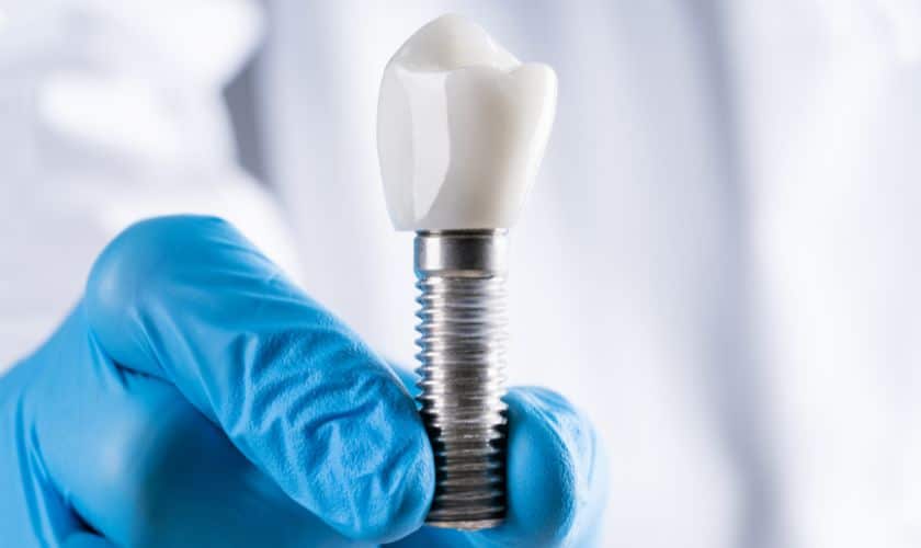 The Benefits of Dental Implants: Overland Park’s Solution for Missing Teeth