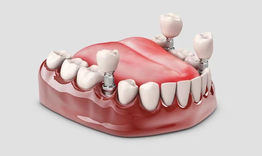 How Do Same-Day Dental Crowns Work? A Step-by-Step Guide for Leawood Patients