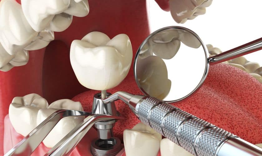 Are Dental Implants Right For You? Assessing Candidacy And Expectations In Lenexa