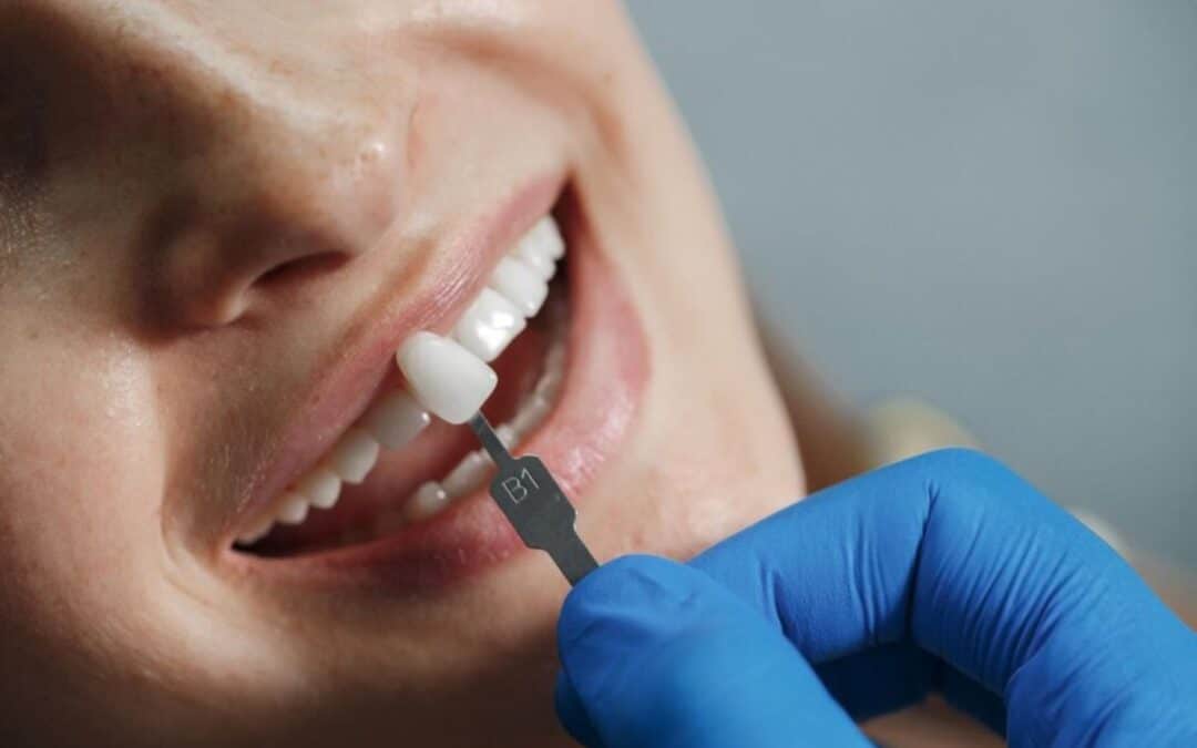 How Veneers Can Transform Your Smile: A Comprehensive Guide