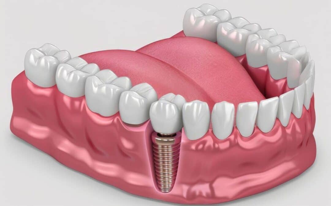 What Are the Signs That I Might Need a Dental Filling or Crown?