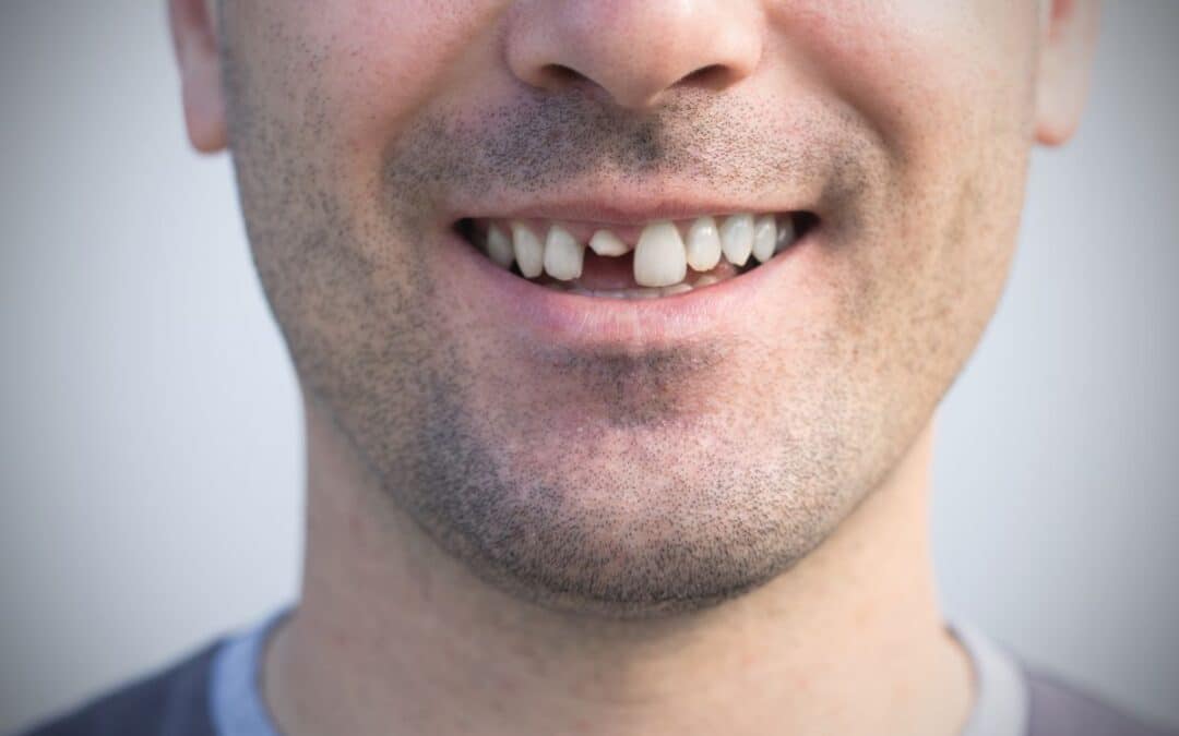 Top 5 Treatments for Fixing a Broken Front Tooth