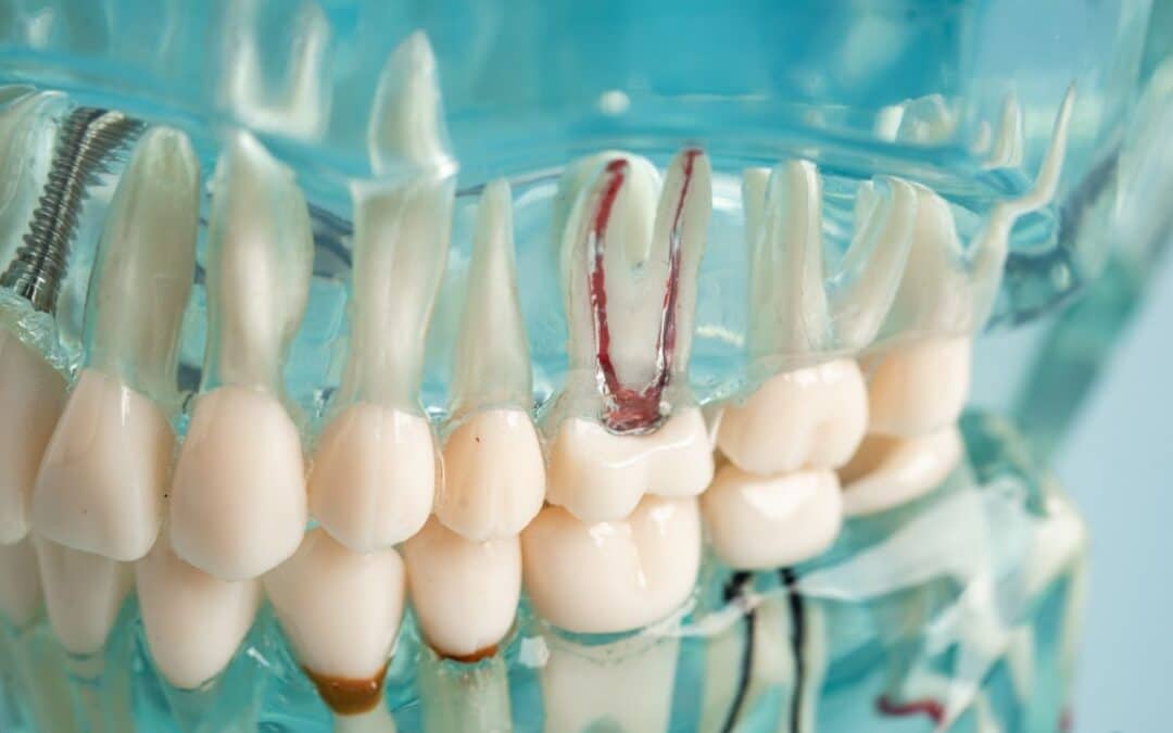 Root Canal Therapy for Children: What Parents Should Know