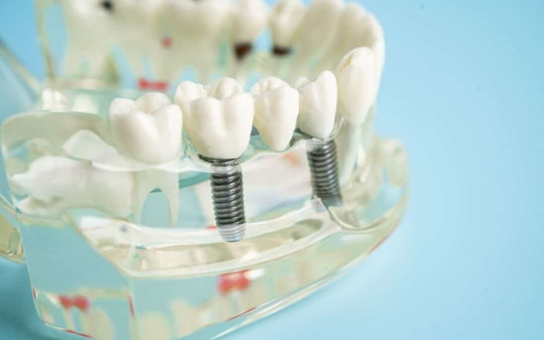 Top 7 Reasons to Avoid Dairy After Getting Dental Implants