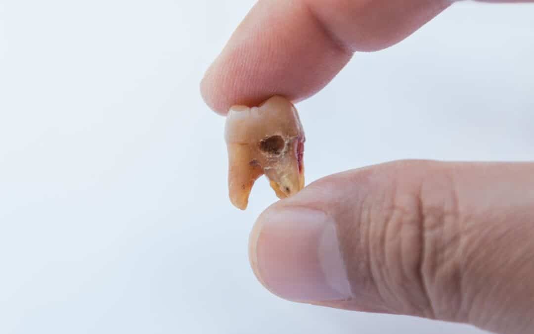 Tooth Decay on the Side of Your Tooth: Early Signs and Symptoms