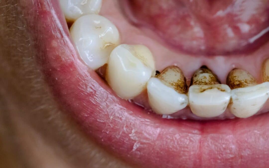 Black Lines On Teeth: What They Mean And How To Treat Them