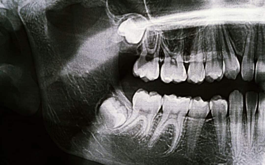 Can Wisdom Teeth Cause Headaches? Signs You Shouldn’t Ignore