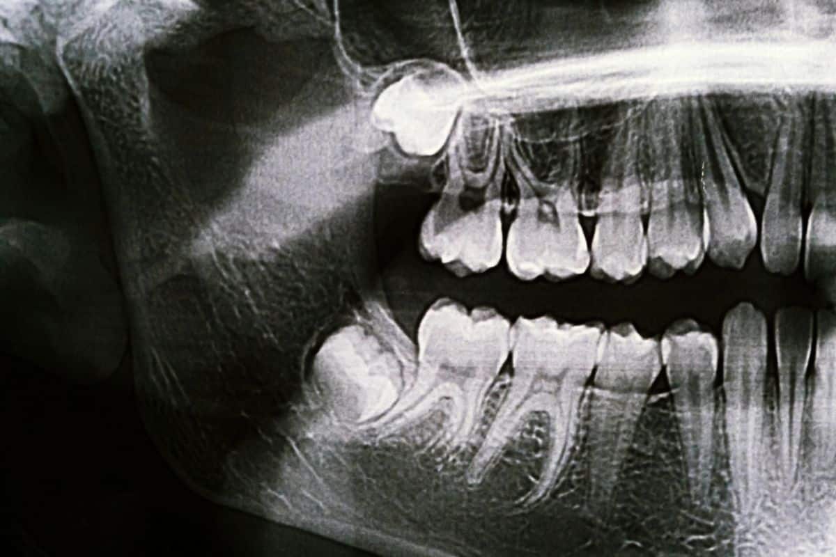 Can Wisdom Teeth Cause Headaches