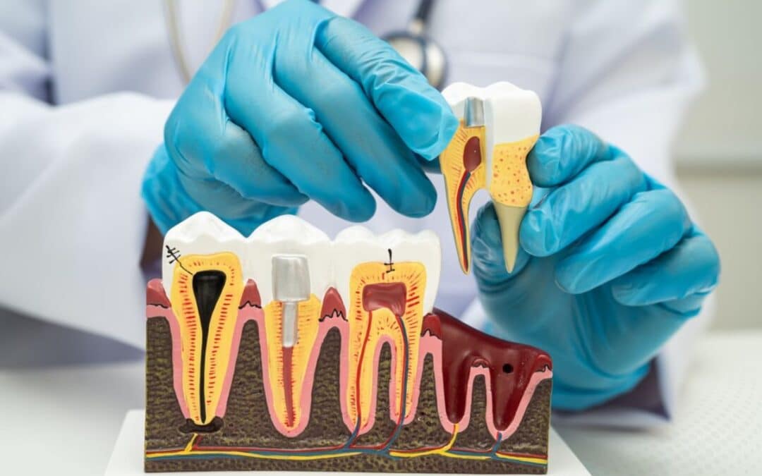 Dentist-Approved Tips to Prevent Root Canals