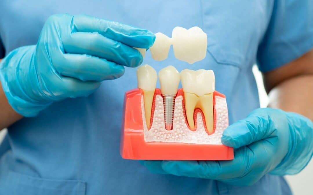 Can Dental Crowns Be Whitened? The Truth Revealed