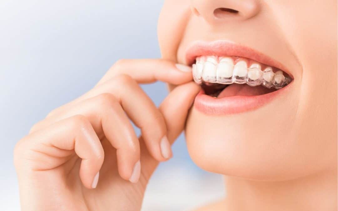 Does Invisalign Hurt? What to Expect During Treatment