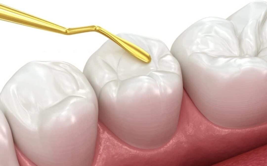 What Happens When You Get a Dental Filling? Step-by-Step Procedure Explained