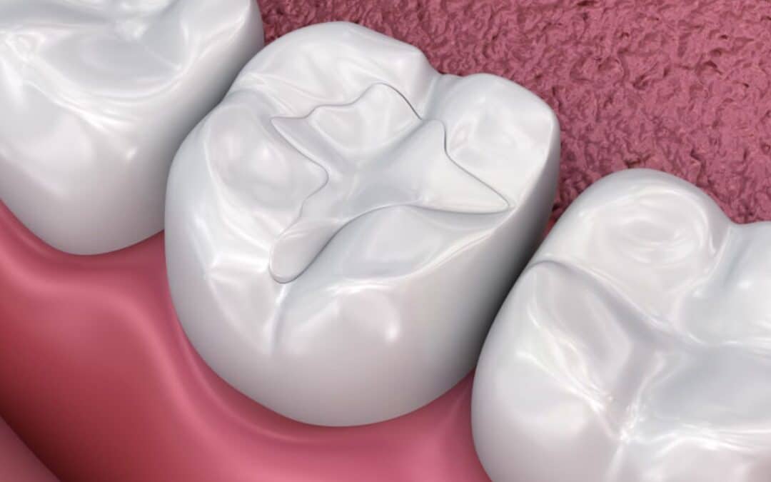 How Long After a Dental Filling Can I Eat? Tips for Quick Recovery