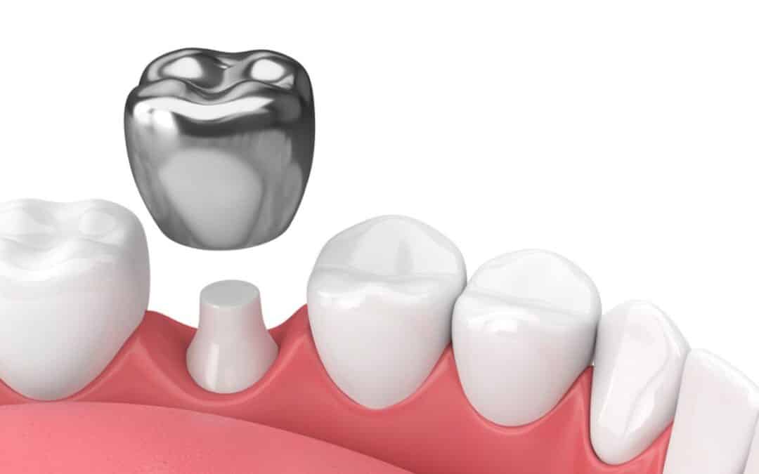 Do Dental Crowns Hurt? What to Expect During the Procedure