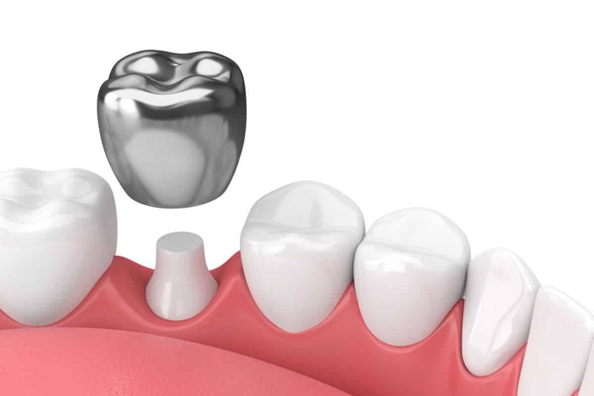 do-dental-crowns-hurt