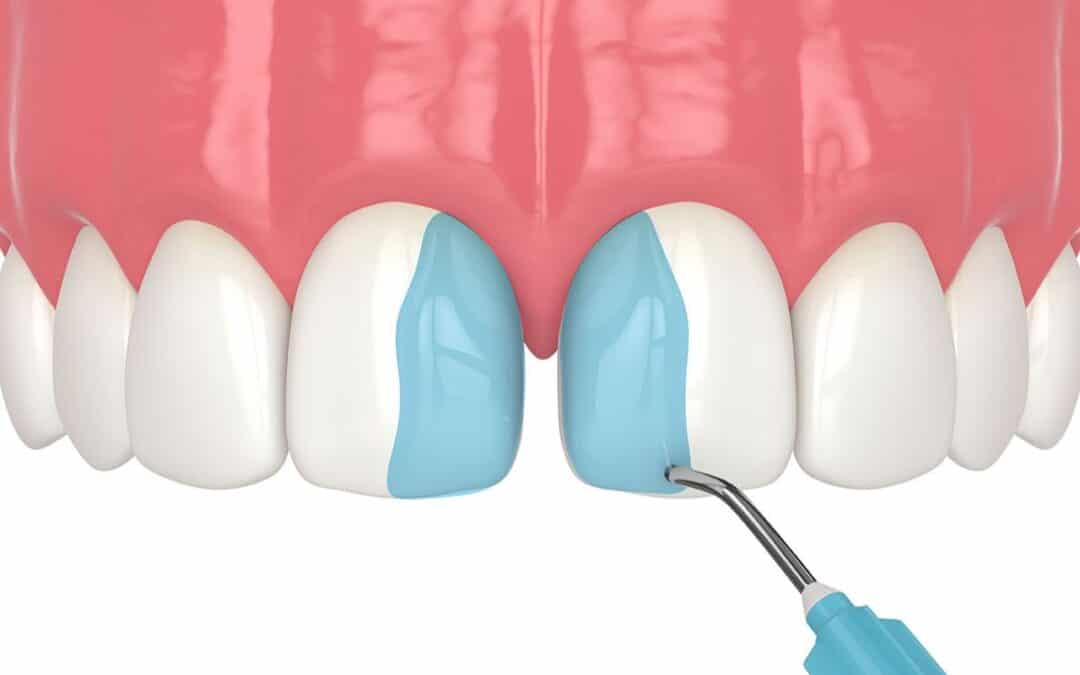 Can Tooth Bonding Be Removed? Here’s What to Expect