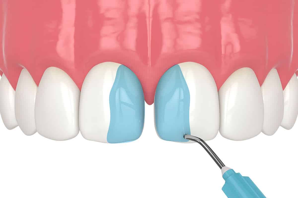 Can Tooth Bonding Be Removed