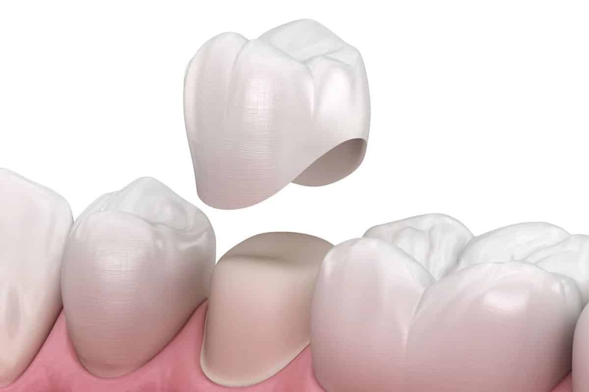Dental Crowns