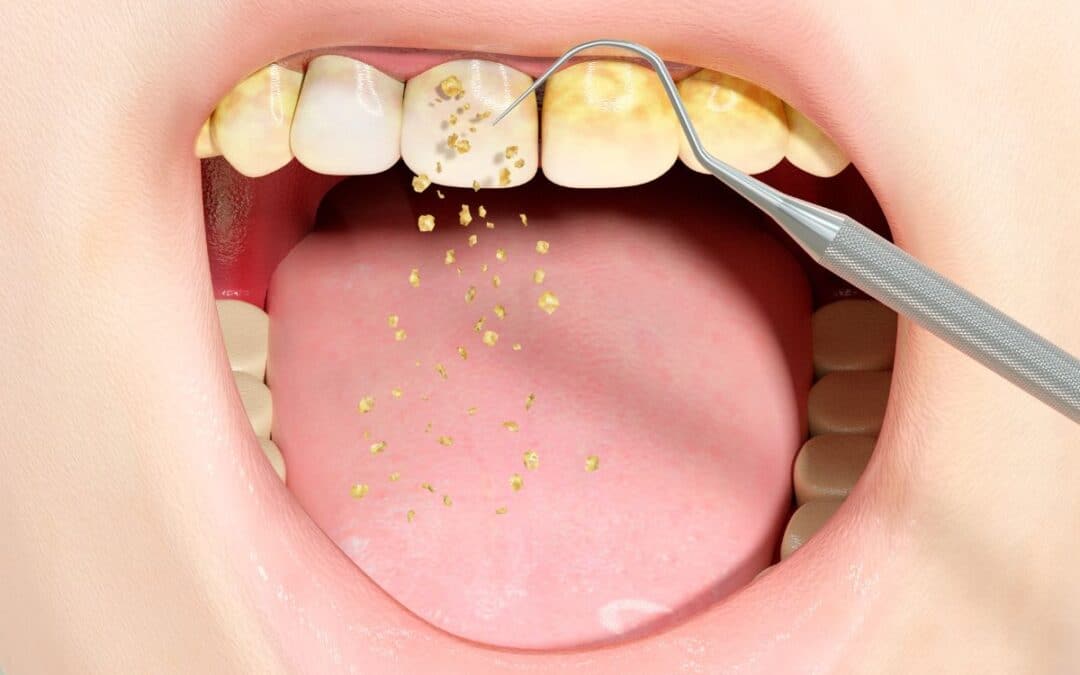 Removing Tartar From Teeth: A Dentist-Guided Approach For Leawood Residents