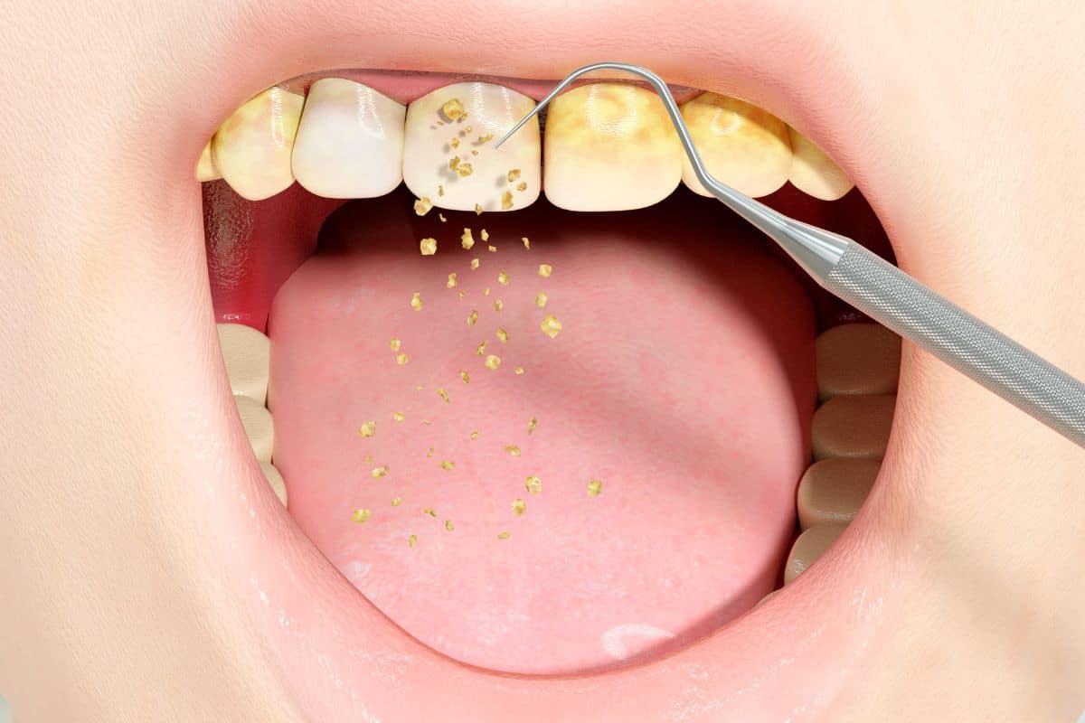 Removing Tartar From Teeth