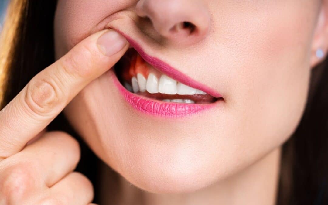 Pus or Swelling Around a Tooth: Is It an Emergency?