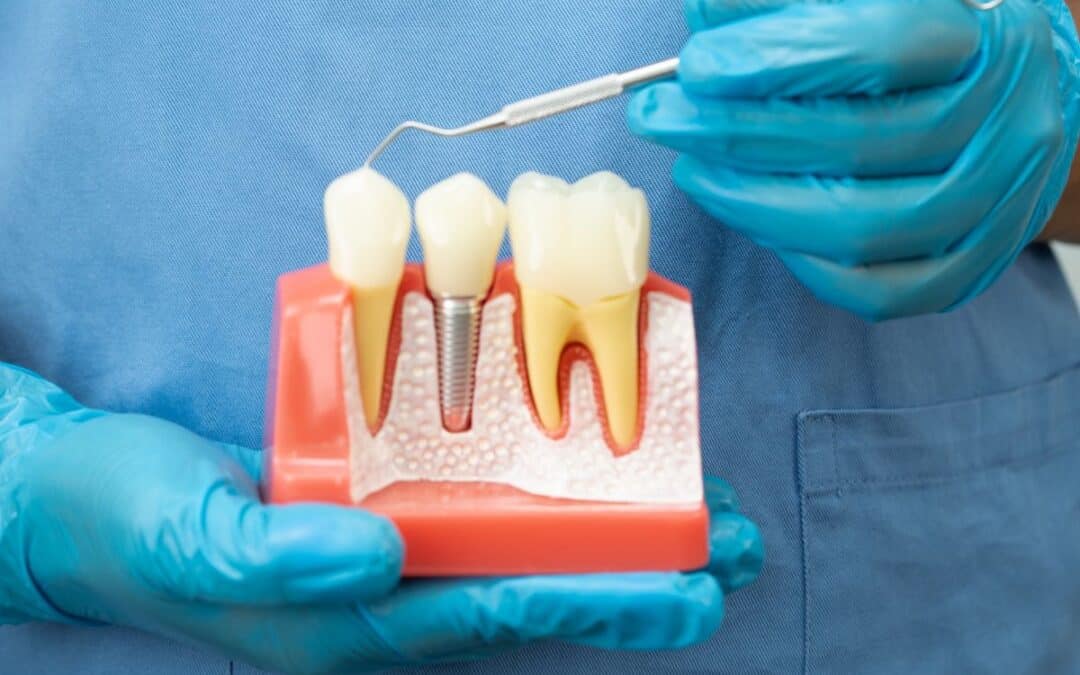 How Bone Density Affects Your Dental Implant Success: What You Need to Know