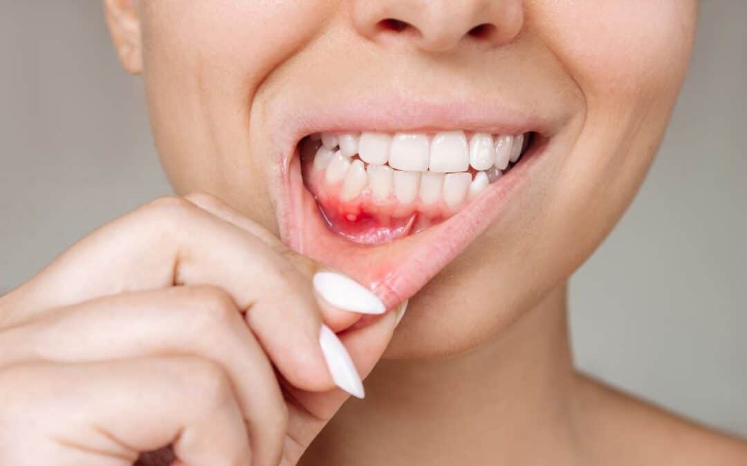 What Causes Recurring Mouth Ulcers Beyond Canker Sores