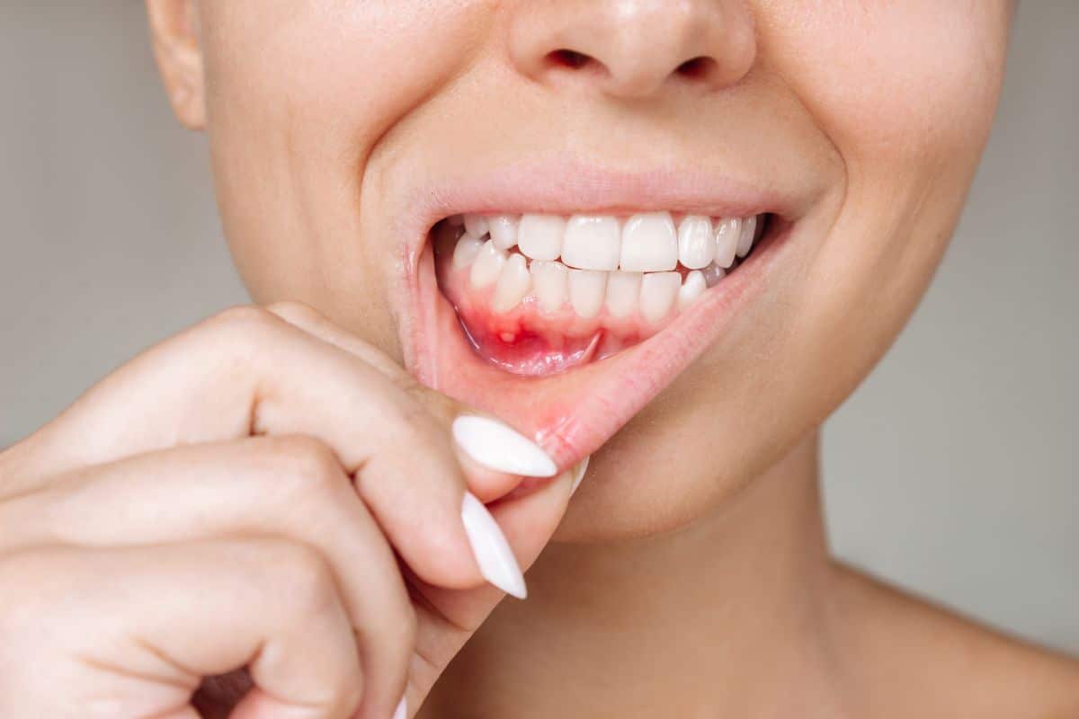 Recurring Mouth Ulcers Causes Recurring mouth ulcers causes and oral health concerns