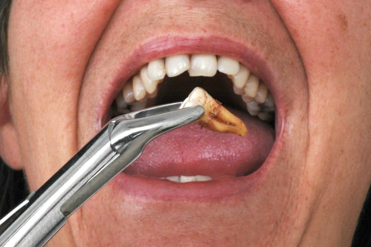 Second Molar Extraction Bite Effects Second molar extraction bite effects after tooth removal